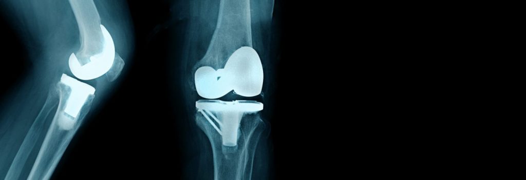 Total Knee Replacement